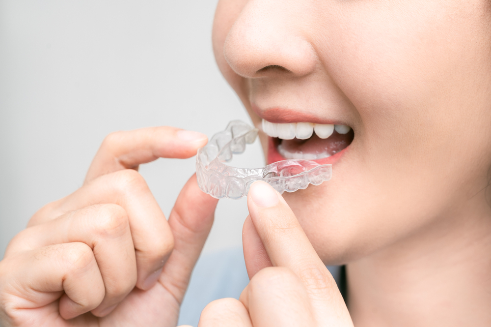 invisalign