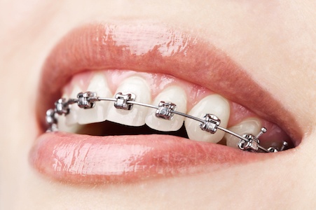 Dental Braces in Vista