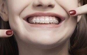 Clear Braces in Vista