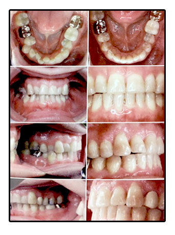 Invisalign Procedure in Vista