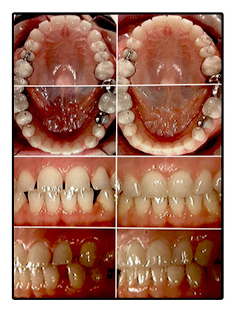 Invisalign Procedure in Vista